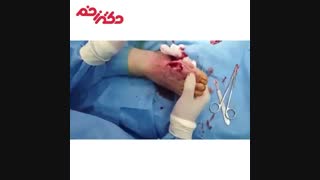 نجات پای بیمار دیابتی از قطع شدن توسط متخصصین مجموعه دکتر زخم