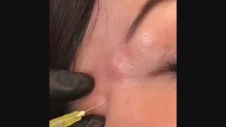 تزریق بوتاکس جهت رفع خطوط پنجه کلاغی کنار چشم | دکتر صفیه چعباوی زاده جراحی لثه