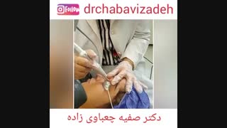 رفع گزانتوم پلک با لیزرco2 | دکتر صفیه چعباوی زاده لیپوست