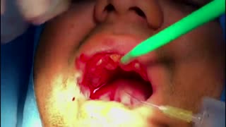 کاشت ایمپلنت سریع با کمک راهنمای جراحی|کلینیک دندانپزشکی مدرن