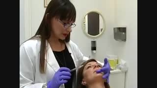 تزریق ژل فیلر به لب