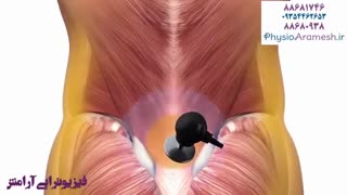 درمان نقاط ماشه ای به روش rf فیزیوتراپی