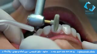 طراحی لبخند، قبل و بعد ونیر کامپوزیت دندان - کلینیک دندانپزشکی کوروش مشهد