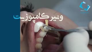 جشنواره زیبایی دندانپزشکی کوروش | تخفیف ویژه کامپوزیت دندان در مشهد