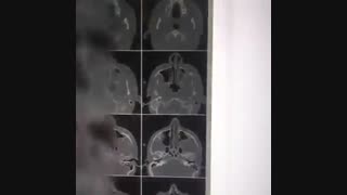 شکستگی گونه لیفت صورت