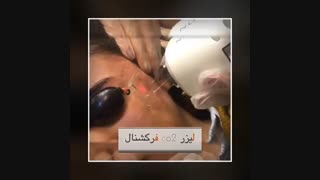 لیزر فرکشنال co2