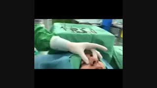 جراحی بینی گوشتی با پوست ضخیم