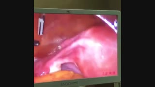 در آوردن رحم  به کمک لاپاراسکوپ