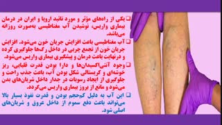 درمان و پیشگیری بیماری واریس