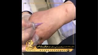 کربوکسی تراپی لیفت پیشانی