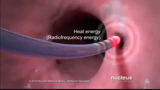 عمل جراحی تپش قلب (ابلیشن)