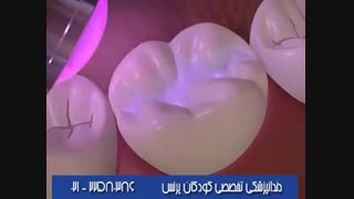 ویدیو کوتاه از شیاربندی دندان ها و فیشورسیلانت