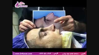 عمل زیبایی بینی آقایان توسط دکتر کاوان