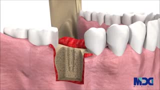 مراحل انجام کاشت دندان