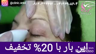 رفع افتادگی پلک با پلاسماجت
