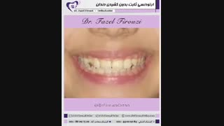 ارتودنسی بدون کشیدن دندان | دکتر فیروزی