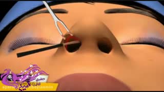 عمل زیبایی بینی (رینوپلاستی )