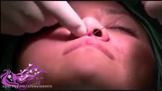 لیفت بینی با نخ (کوچک کردن بینی)