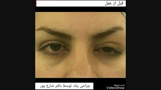 جراحی افتادگی پلک