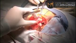 نتیجه جراحی سر و گردن