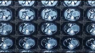 جراحی تومور کلیه | دکتر محمد رنجبری