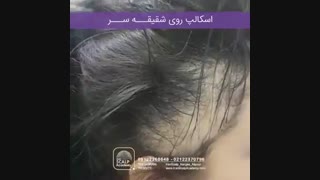 اسکالپ شقیقه سر