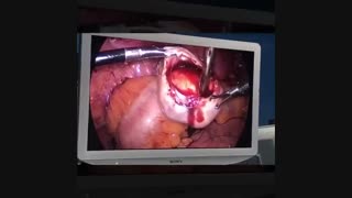 لاپاراسکوپی کیست تخمدان