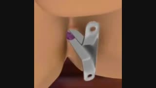 لیزر هموروئید