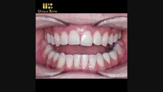 اصلاح طرح لبخند | دکتر عطایی
