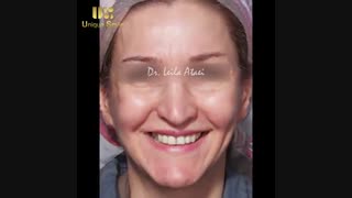 اصلاح طرح لبخند | دکتر لیلا عطایی