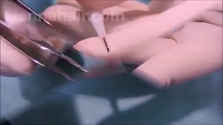 کاشت مو با Micro FUE و Pen Implanter