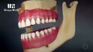 تحلیل ریشه ی دندان | دکتر لیلا عطایی