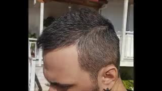 مراحل پیشرفت و رشد کاشت مو از صفر تا 12 ماه