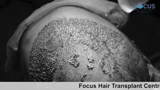 ایمپلنت کاشت مو