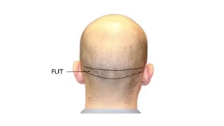 چگونه یک روش کاشت مو مناسب انتخاب کنیم؟