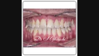 تنگی فک | دکتر سعید قریشی