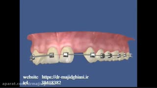 ایمپلنت دندان -دکترمجیدقیاسی بهترین دندانپزشک زیبایی درمشهد