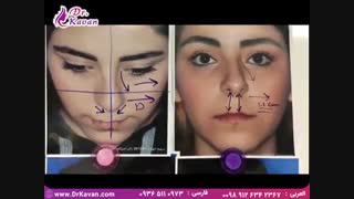 جراحی زیبایی بینی توسط دکتر کاوان