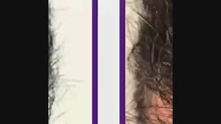 اسکالپ برای افراد دچار ریزش مو