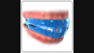محافظ دندان در ارتودنسی | دکتر قریشی