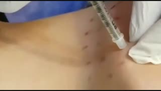 رفع غبغب با مزوتراپی