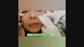 تزریق فیلر زیر چشم