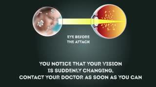 6 هشدار نشان می دهد که یک سکته مغزی رخ می دهد