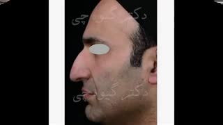 جراحی بینی آقایان