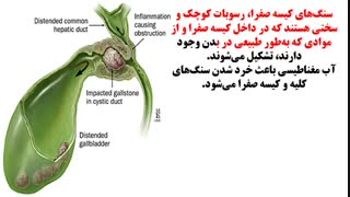 پیشگیری و درمان سنگ کیسه صفرا