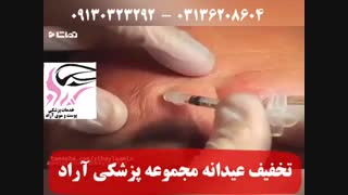 نحوه تزریق بوتاکس پیشانی و اثر آن