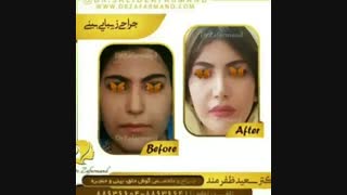 نمونه کار عمل بینی