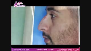 جراحی زیبایی بینی آقایان