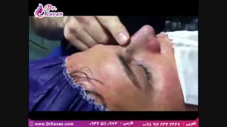 عمل  بینی گوشتی توسط دکتر کاوان