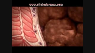 بواسیر چیست و چگونه ایجاد می‌شود؟